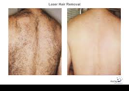 Dauerhafte Haarenternung durch Laser